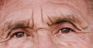 Discover the lasting and painless effects of eyelid surgery